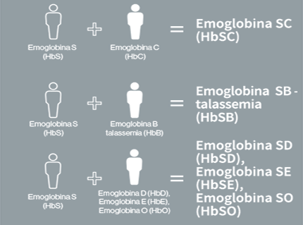 Le tipologie di anemia falciforme comprendono HbSS, HbSC, HbS-talassemia, HbSD, HbSE e HbS0